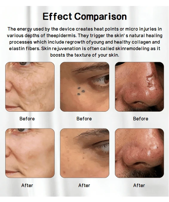 JY-FL5 CO₂ Fractional Laser: Product Results Demonstration Image 1